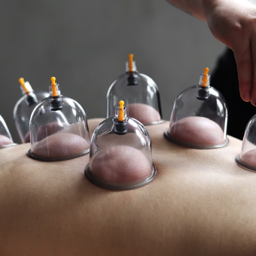 cupping-Christopher-Horsford-Physical-Therapy-Shirley-NY